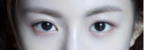 뒷트임 후 눈뜨기가 쉬워요 [성형외과 전문의 안성민] 관련 이미지 5