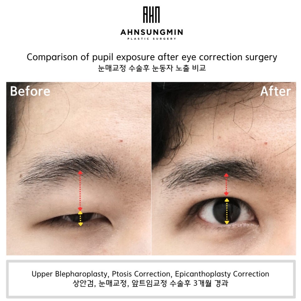 20대 중증 안검하수 수술 후 3개월 경과 관련 이미지 3