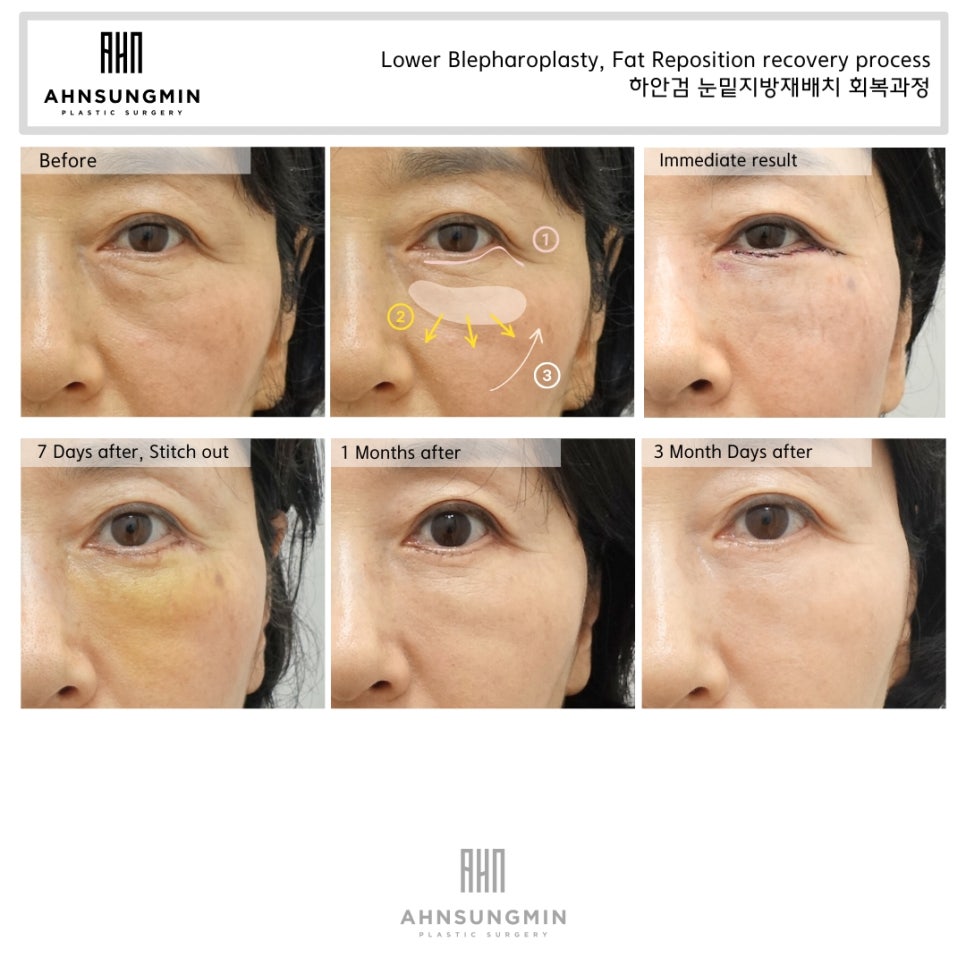 눈 밑주름 해결 50대 여성 하안검 수술 후 3개월 경과 관련 이미지 2