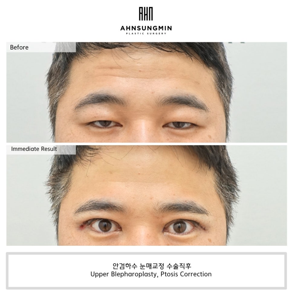 30대 남자 눈매교정 수술 직후 관련 이미지 3