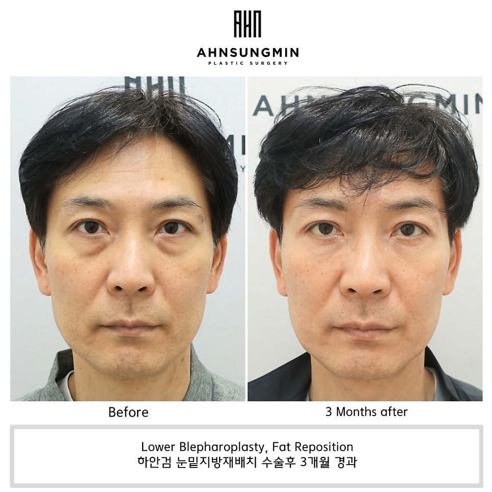 중년 남성 하안검 노화 과정과 각종 처치법 관련 이미지 1