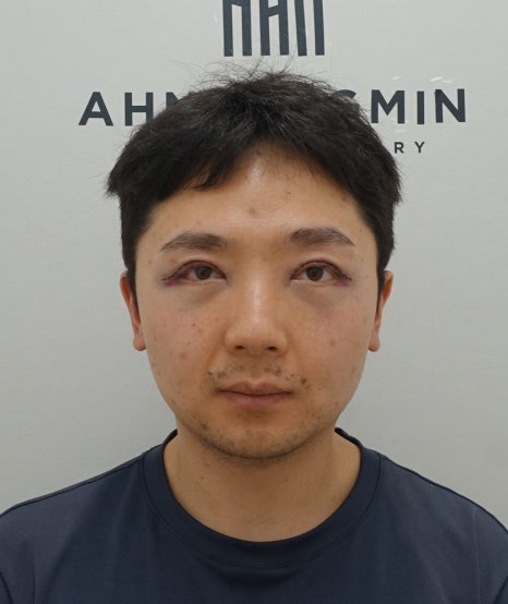 20대 남성 안검하수 증세와 눈매교정 수술 후 3개월 경과 관련 이미지 6