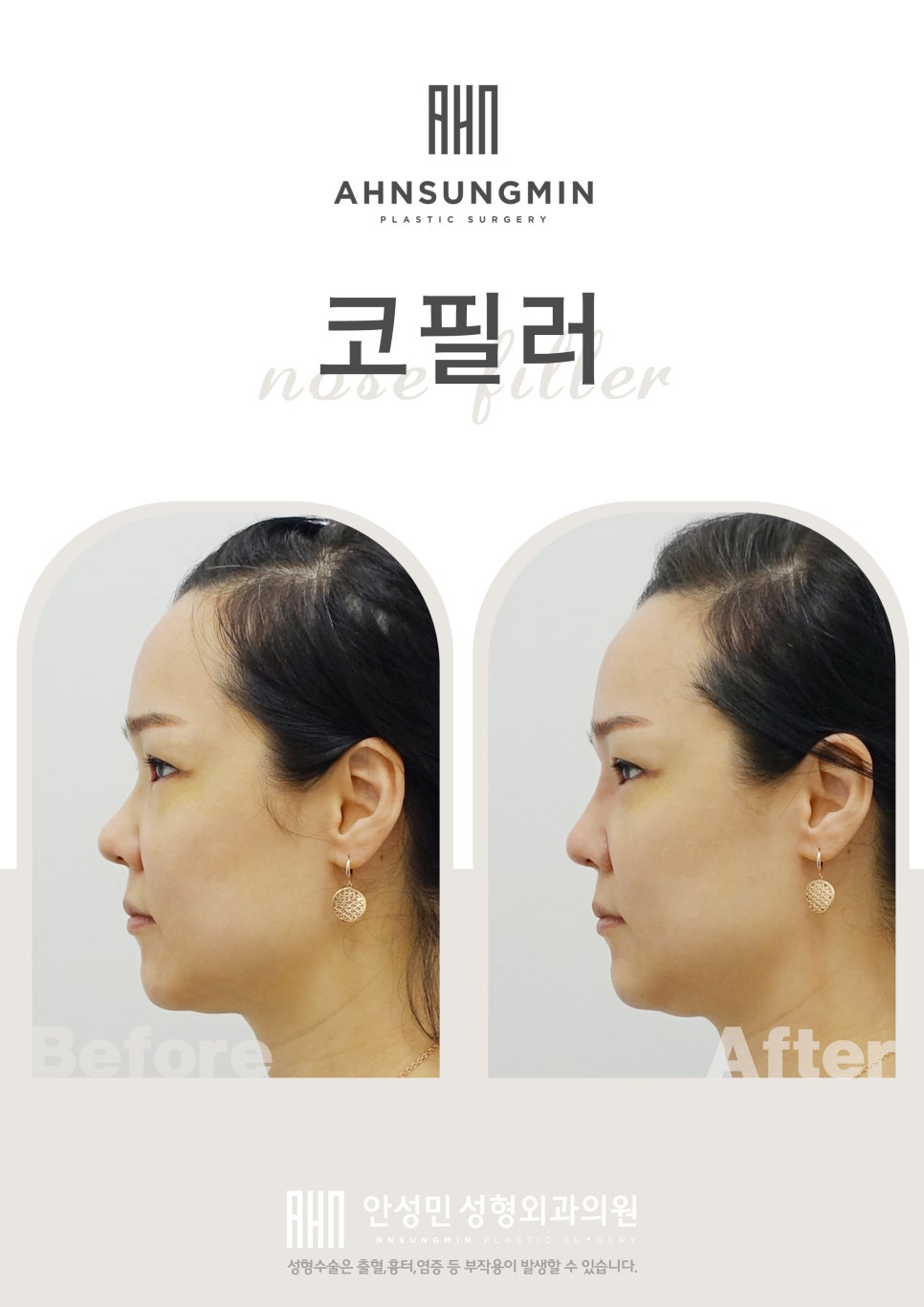 코필러 관련 이미지 1