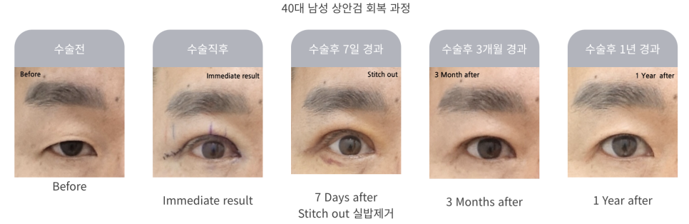 중년 상안검 수술의 특징과 주의사항 관련 이미지 6