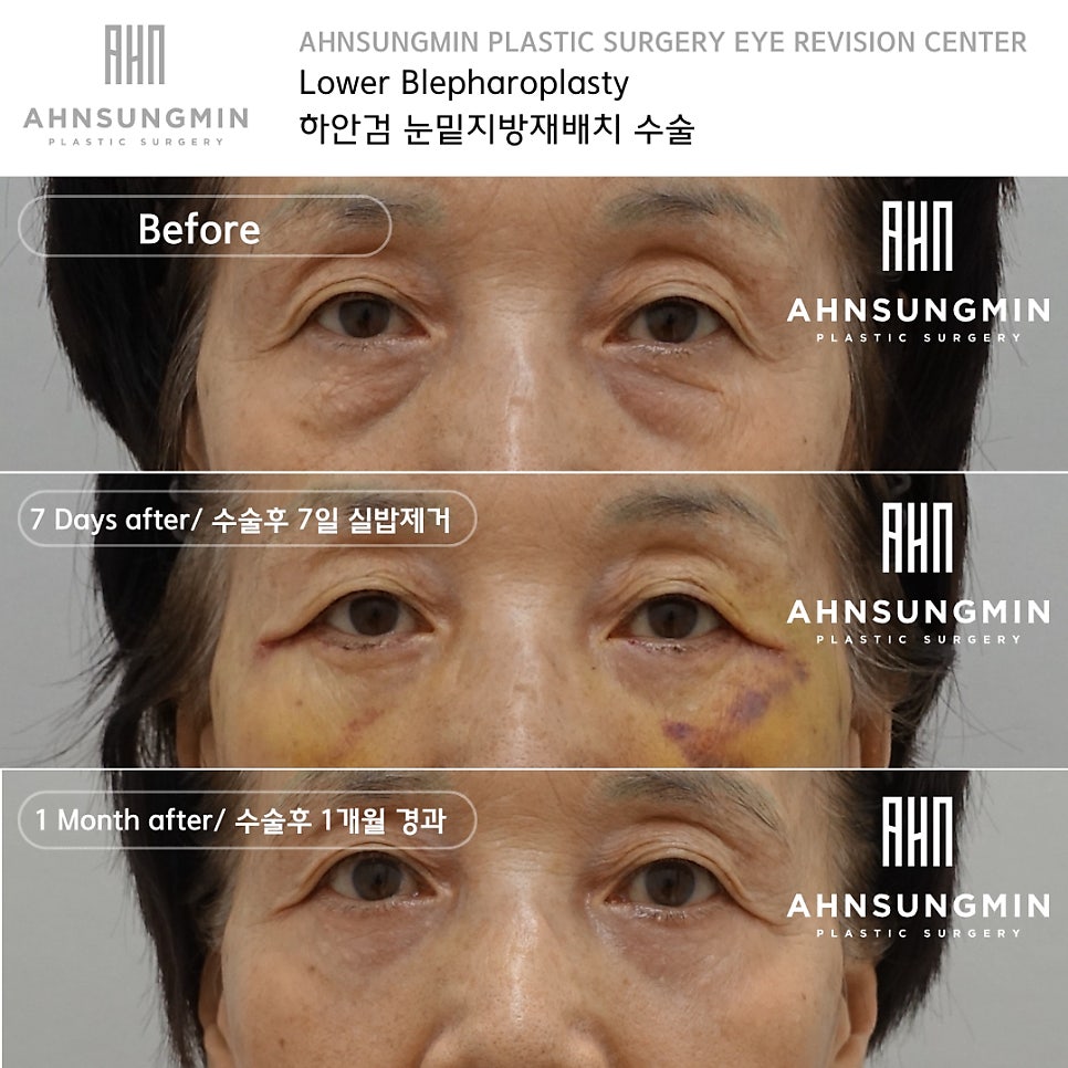 하안검 수술시 중안면 근육 거상의 중요성 [성형외과 전문의 안성민] 관련 이미지 2
