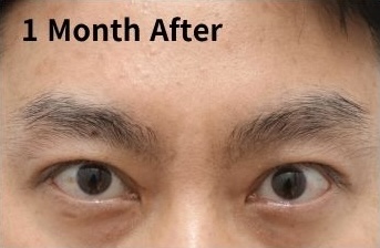 쌍꺼풀 재수술 후 눈은 언제 자연스러워질까? (Day 1부터 6개월 변화) 관련 이미지 6