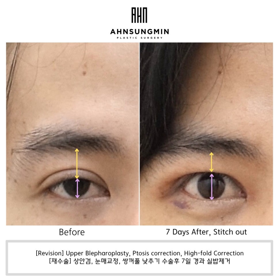 쌍꺼풀이 너무 높은데 재수술이 필요할까요? 관련 이미지 2