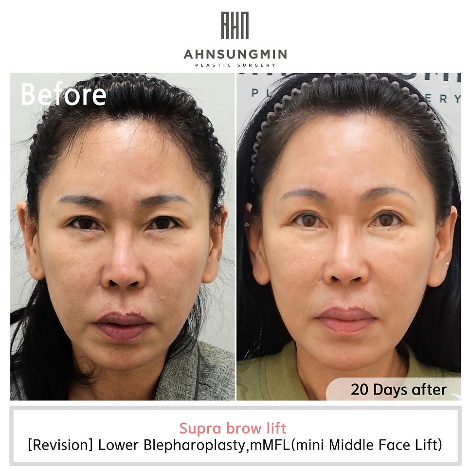 눈썹거상수술 회복후 수술전후 관련 이미지 2