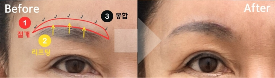 눈썹거상 수술 과정, 5개월 경과 성형외과 전문의 안성민 관련 이미지 2