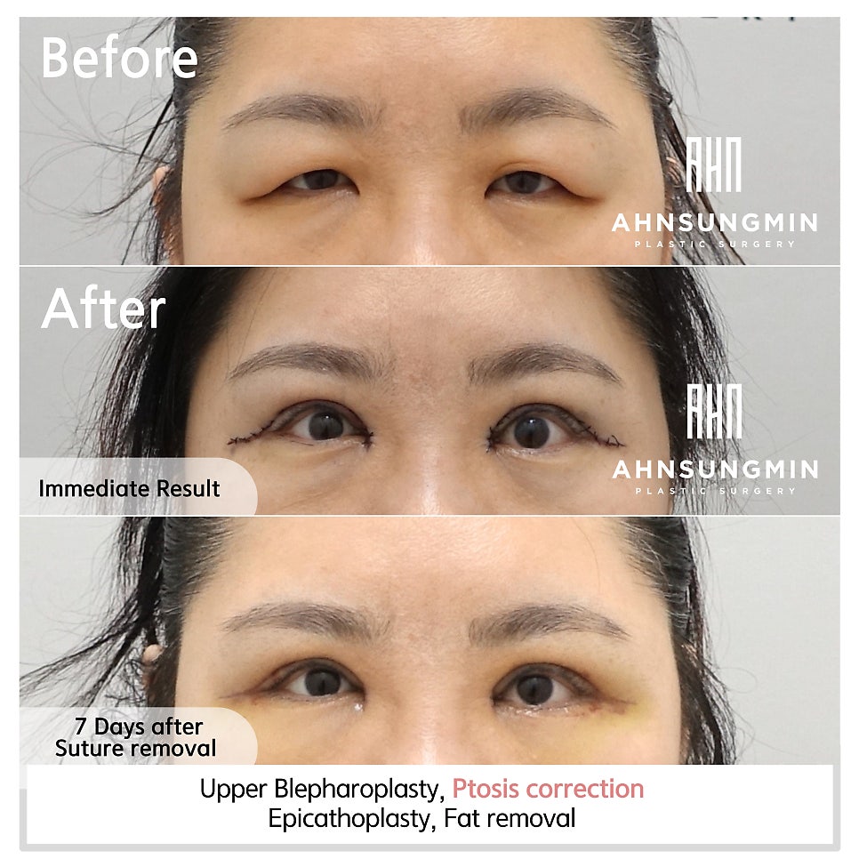 상안검 눈매교정 지방제거 수술 안성민성형외과 관련 이미지 5