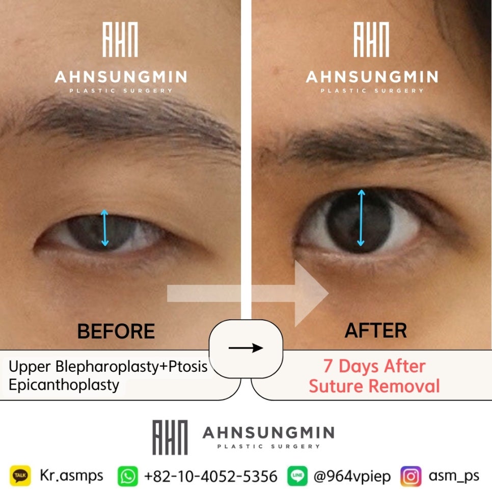 안검하수 눈매교정 수술후 눈동자 크기 변화 관련 이미지 1