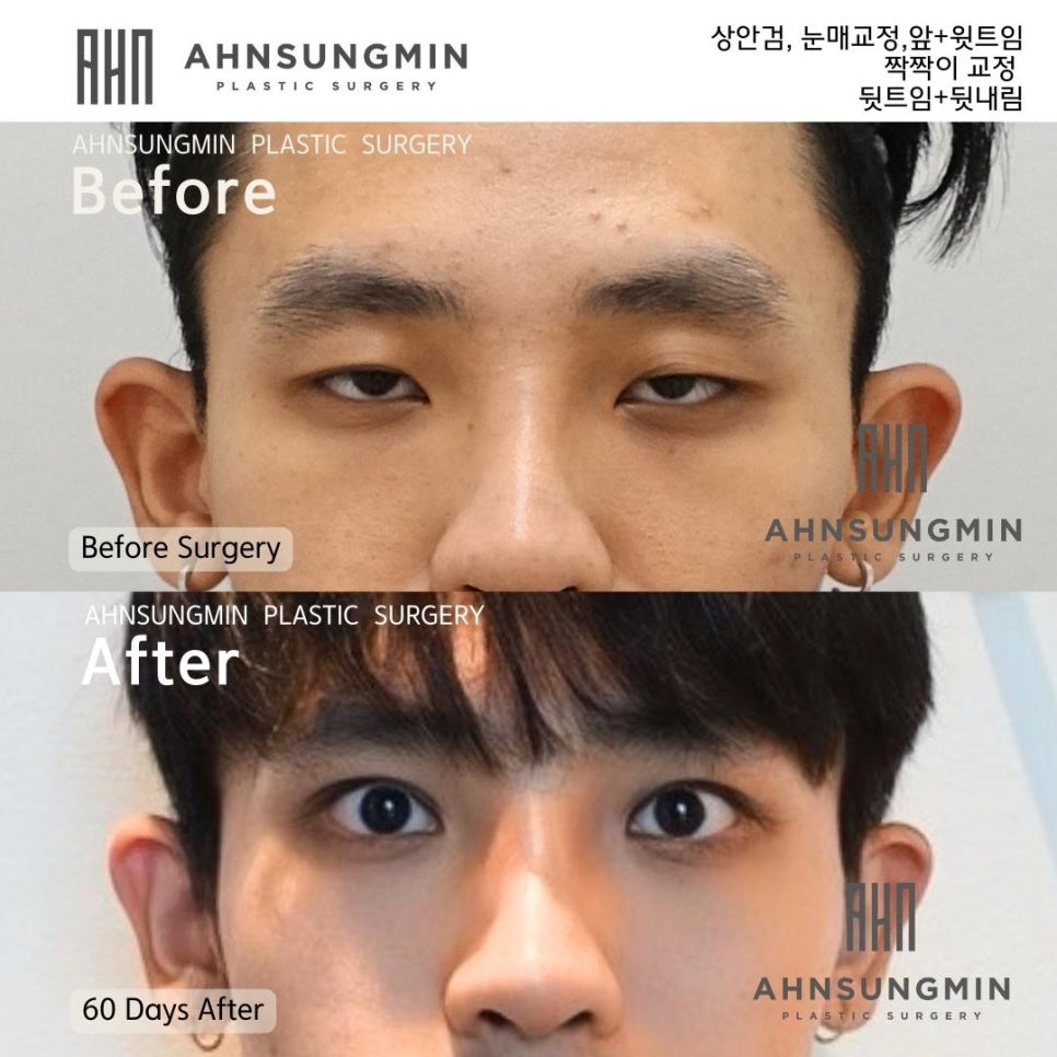 남자안검하수와 트임성형 [ 날카로운눈 온화한 인상으로] 눈이 커지고 싶어요 관련 이미지 3