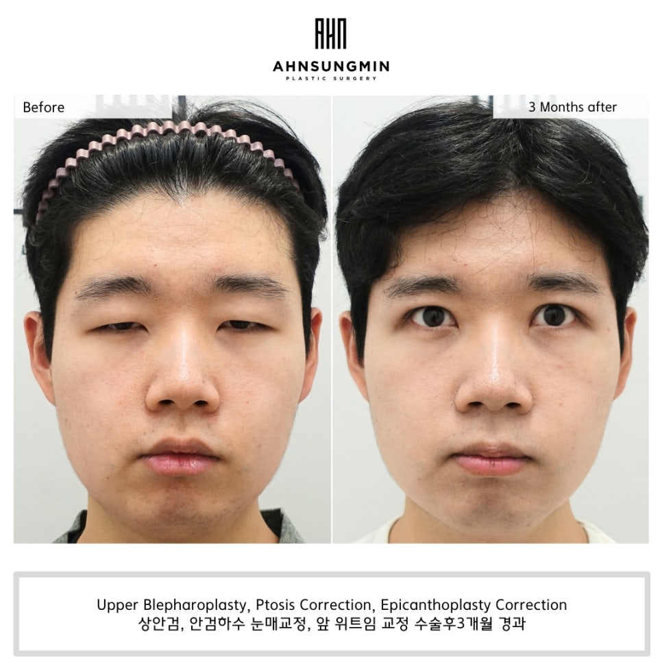 20대 남자 안검하수, 졸린 눈 어떻게 해결할까? 관련 이미지 6