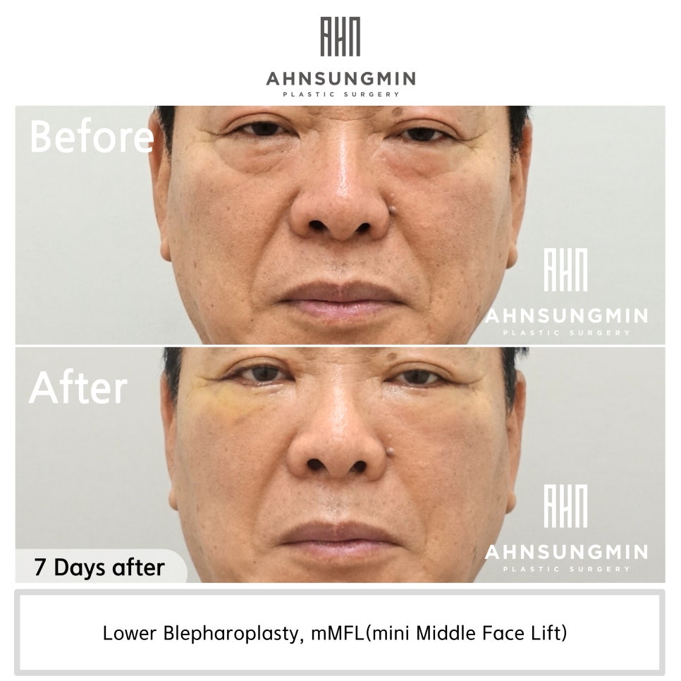 중년남성 하안검 눈밑지방재배치 혈압관리 관련 이미지 2