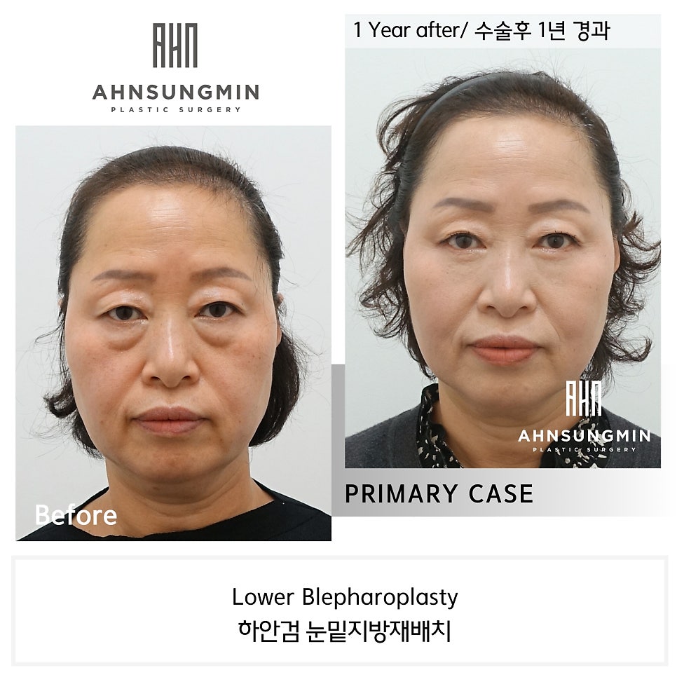 중년 눈 밑 지방 재배치 수술 후 1년 경과 [성형외과 전문의 안성민] 관련 이미지 2