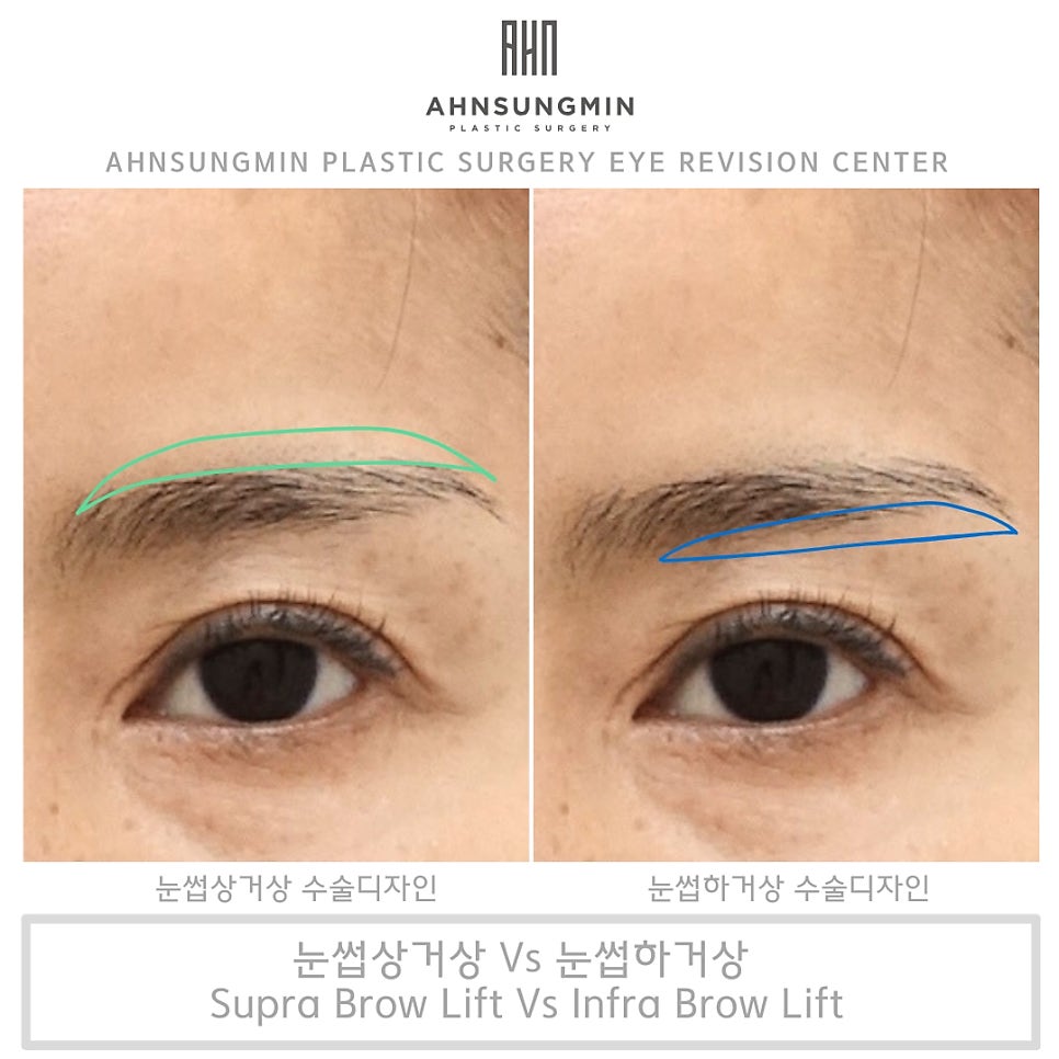 눈썹거상이 왜 필요할까? 눈썹상거상 전문 안성민성형외과 관련 이미지 2