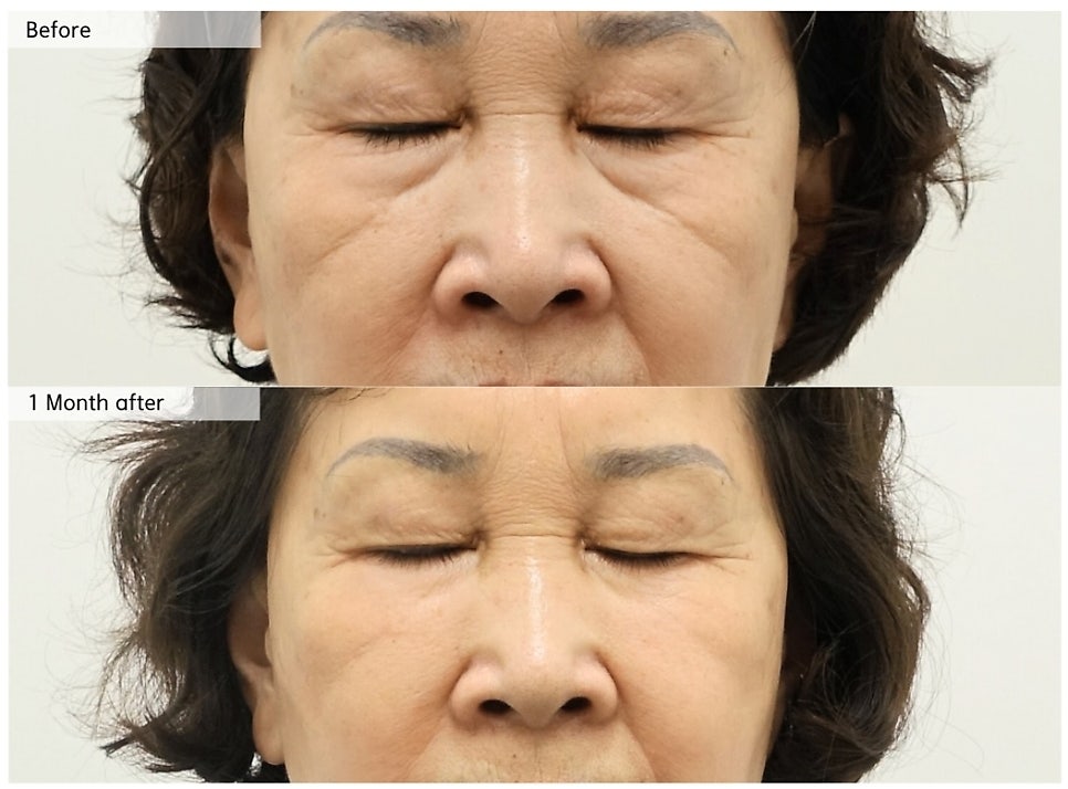 하안검 수술 시 중안면 근육을 당기는 이유 관련 이미지 4