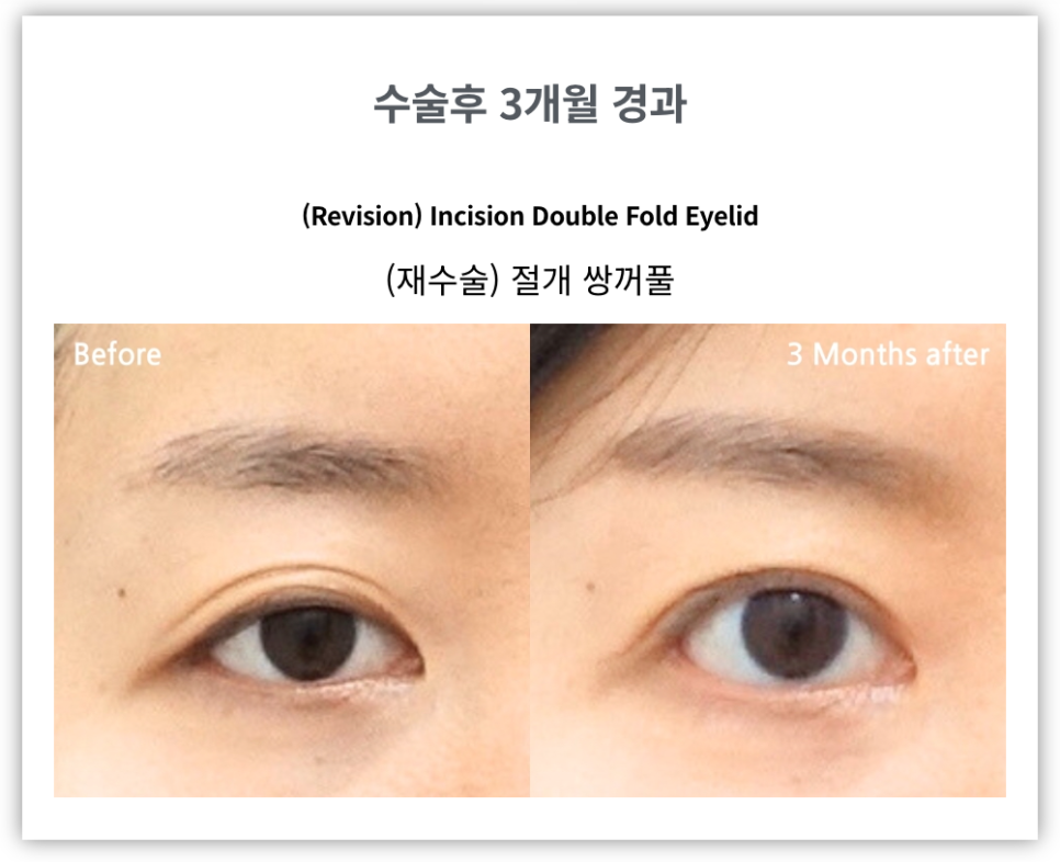절개쌍꺼풀과 비절개쌍꺼풀 비교 관련 이미지 6