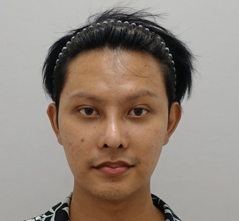 느끼한 남자 눈 무쌍이 되고 싶어요. 두꺼운 쌍꺼풀 낮추기 관련 이미지 7