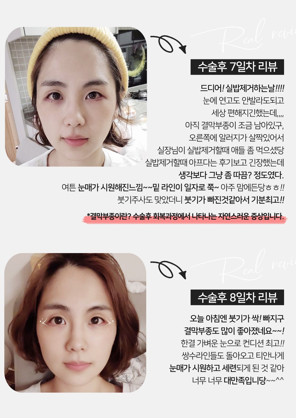 [잠실동성형외과] 듀얼트임 고객님의 리얼후기! 성형후기! 뚜렷한 눈매를 원한다면? 잠실 안성민성형외과! 관련 이미지 4