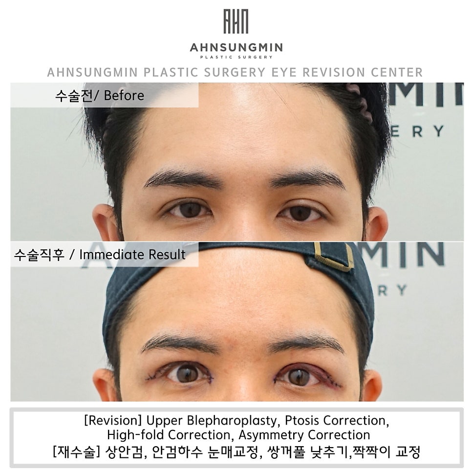 쌍꺼풀 비대칭과 비후증의 원인과 해결 방법, 성형외과 전문의 안성민 관련 이미지 1
