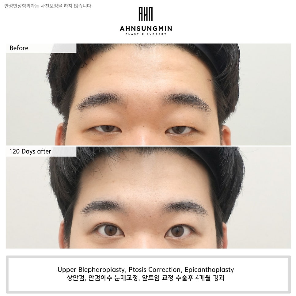 [4개월 경과] 남자 안검하수 수술의 핵심 포인트!! 관련 이미지 2