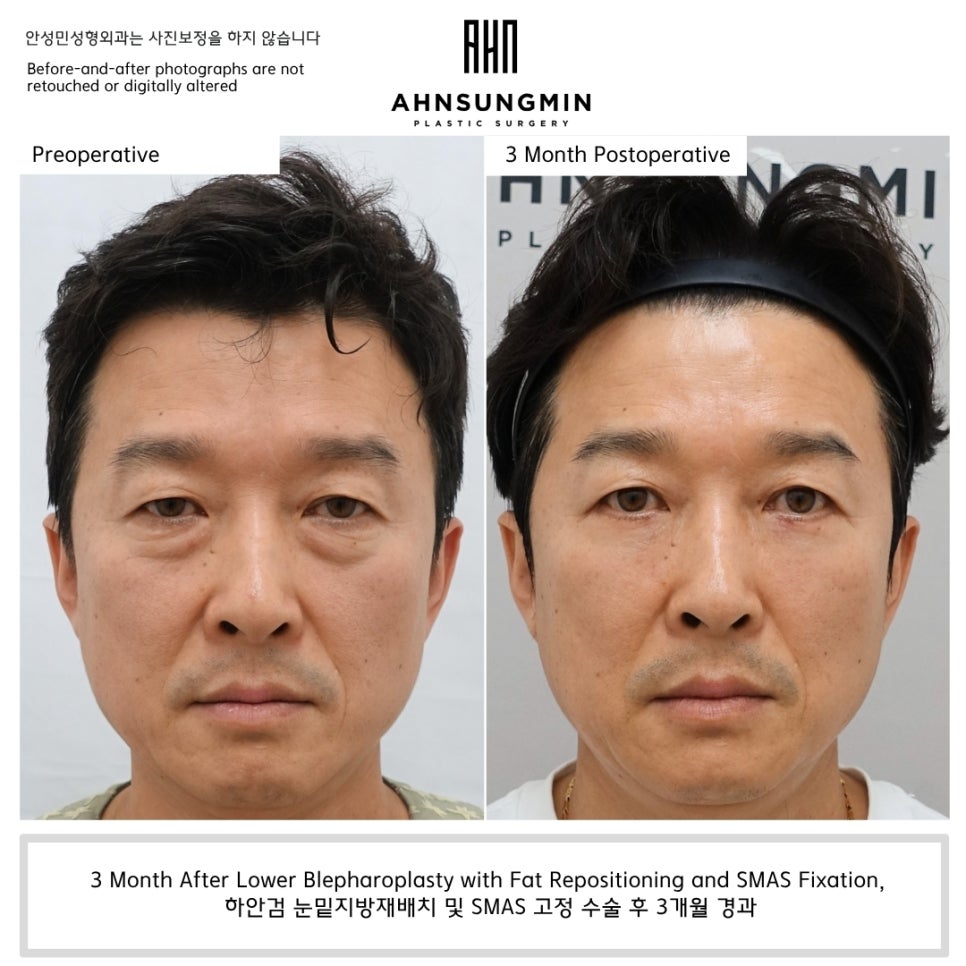 하안검 수술, 결과는 언제부터 자연스러워질까요? 관련 이미지 3