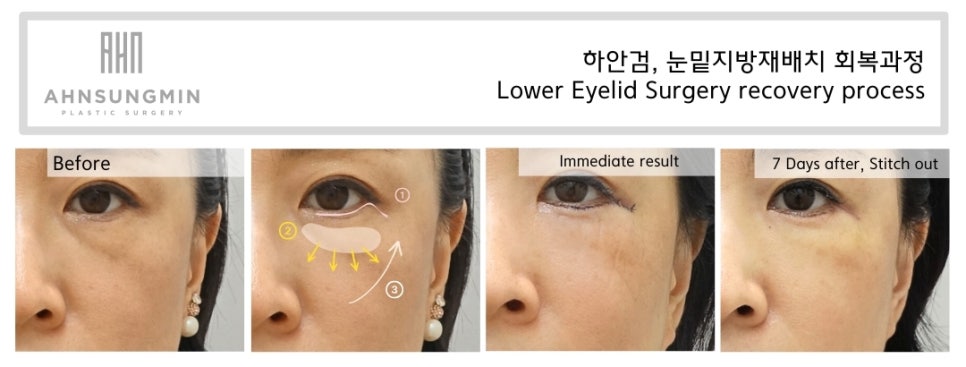 눈밑지방재배치 재수술이 가능할까요? 수술 후 7일 경과 관련 이미지 2