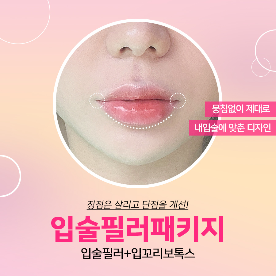 [잠실동성형외과] 절개없이 자연스럽게 예뻐지는 쁘띠성형 / 입술필러 패키지 / 입술필러+입꼬리보톡스 / 잠실성형외과 관련 이미지 1
