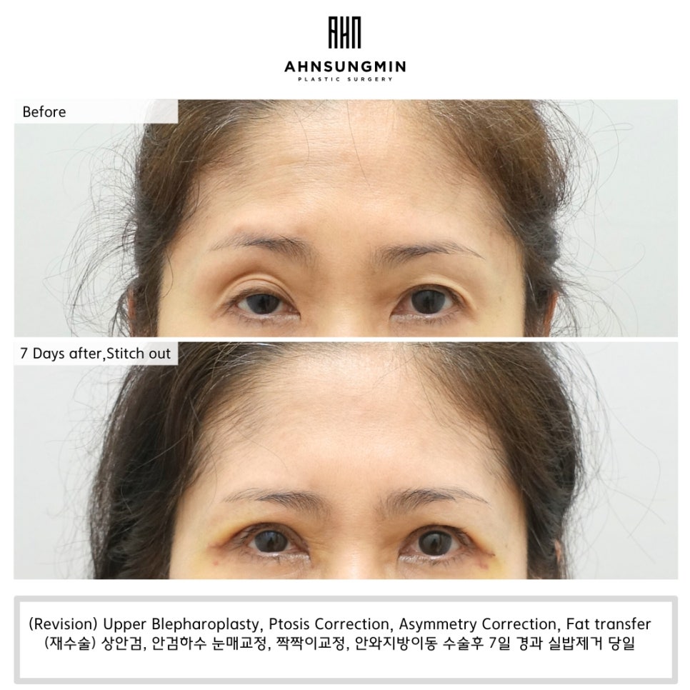 [재수술] 안검하수 짝짝이 교정을 한쪽 눈만 할 수 없는 이유 관련 이미지 4