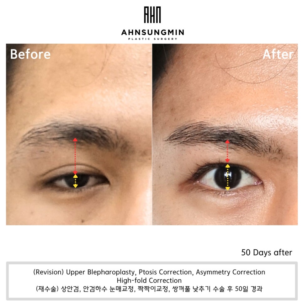 [재수술] 남자 쌍꺼풀이 두꺼워 보이는 원인은 안검하수 관련 이미지 2