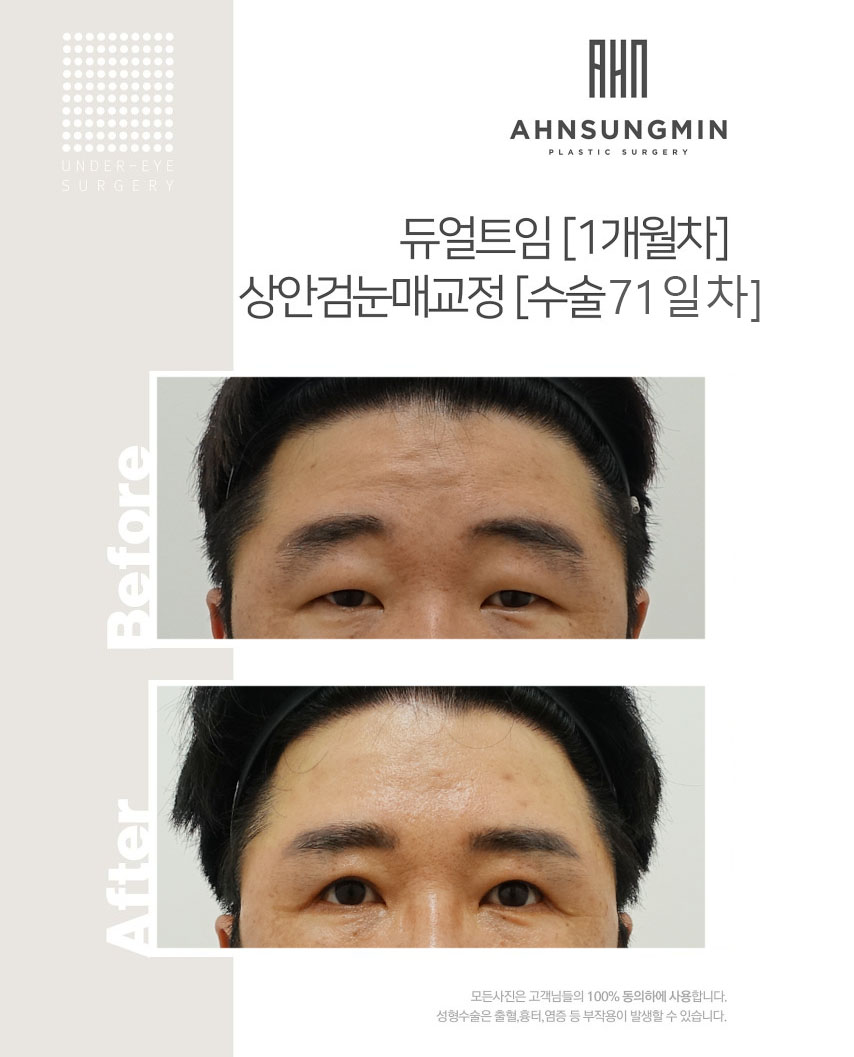 안성민듀얼트임[뒷트임+뒷내림] 관련 이미지 5