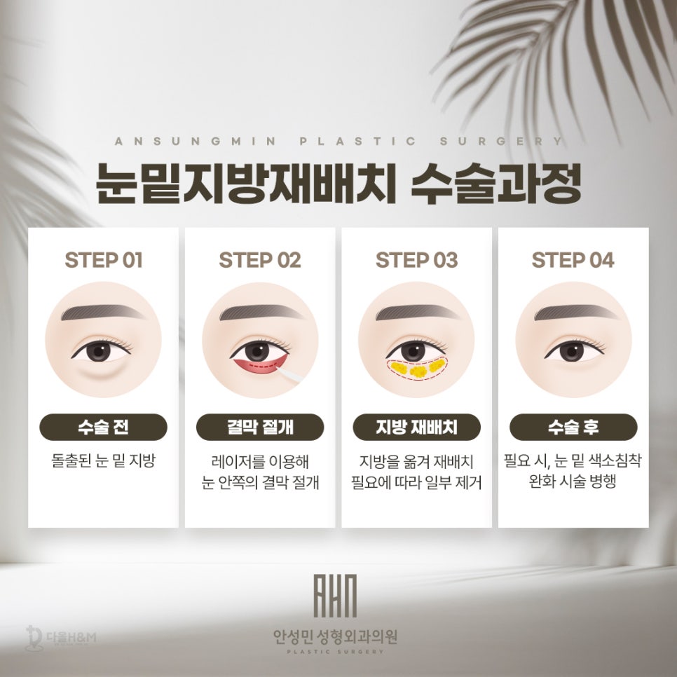 삼성성형외과 눈밑지방재배치 궁금증 풀어드립니다. 관련 이미지 3