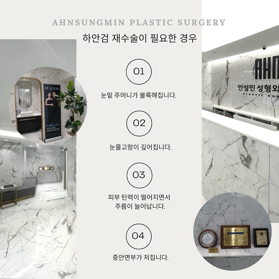 하안검 재수술 잘하려면 [성형외과 전문의 안성민] 관련 이미지 2