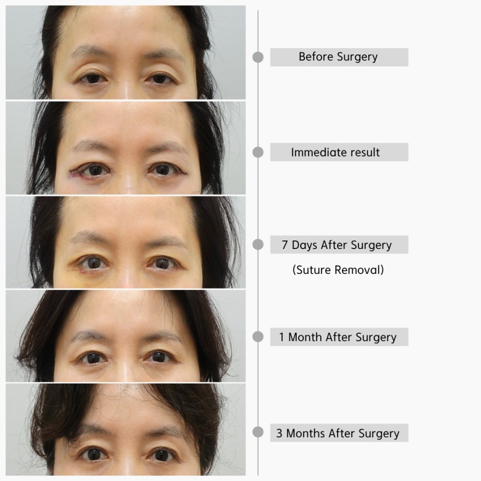 Upper Eyelid Hollowness That Develops With Age Is Not Simply Caused by Fat Loss image 2