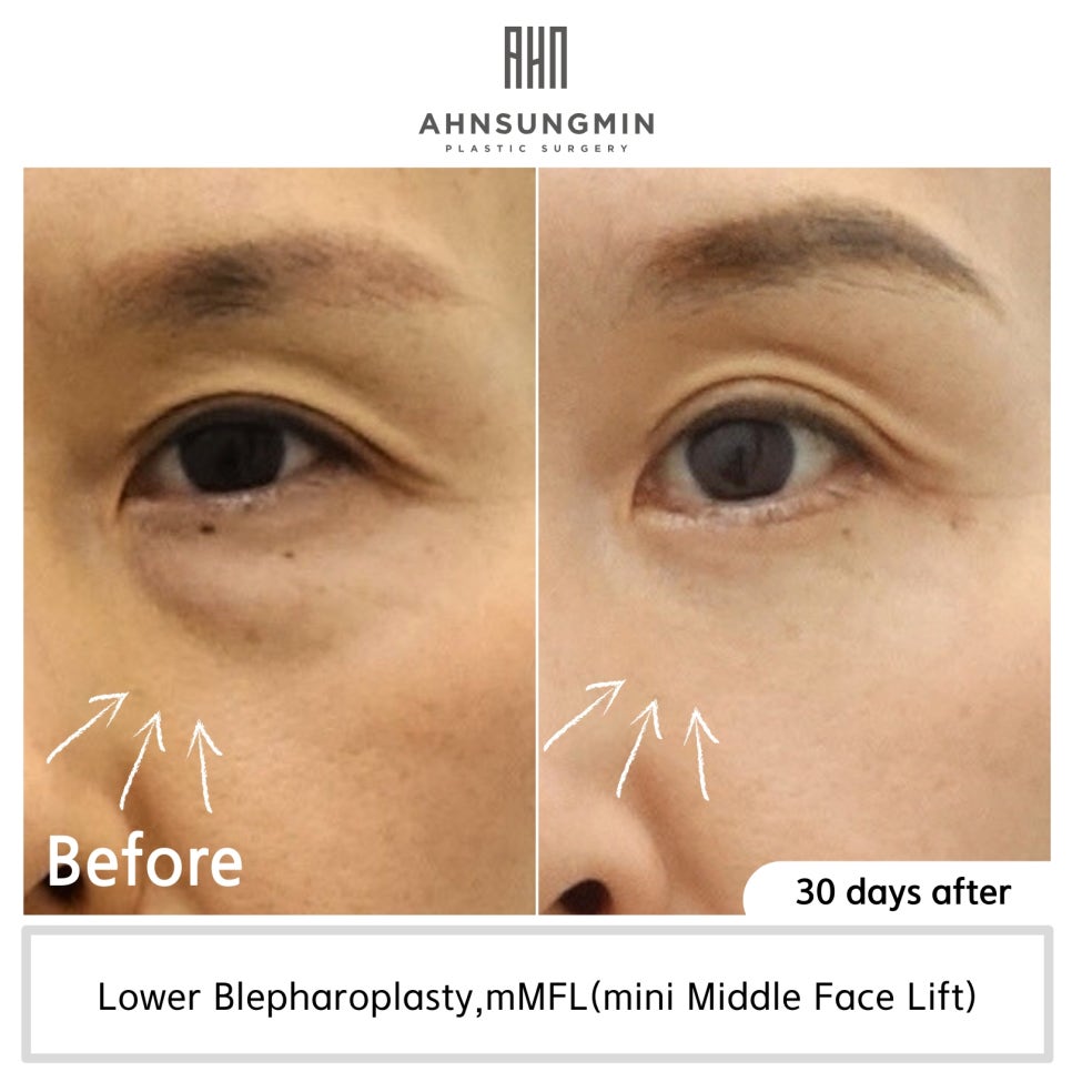 하안검 눈밑지방재배치란 무엇일까요? [지방제거를 하면 안 되는 이유] 관련 이미지 6