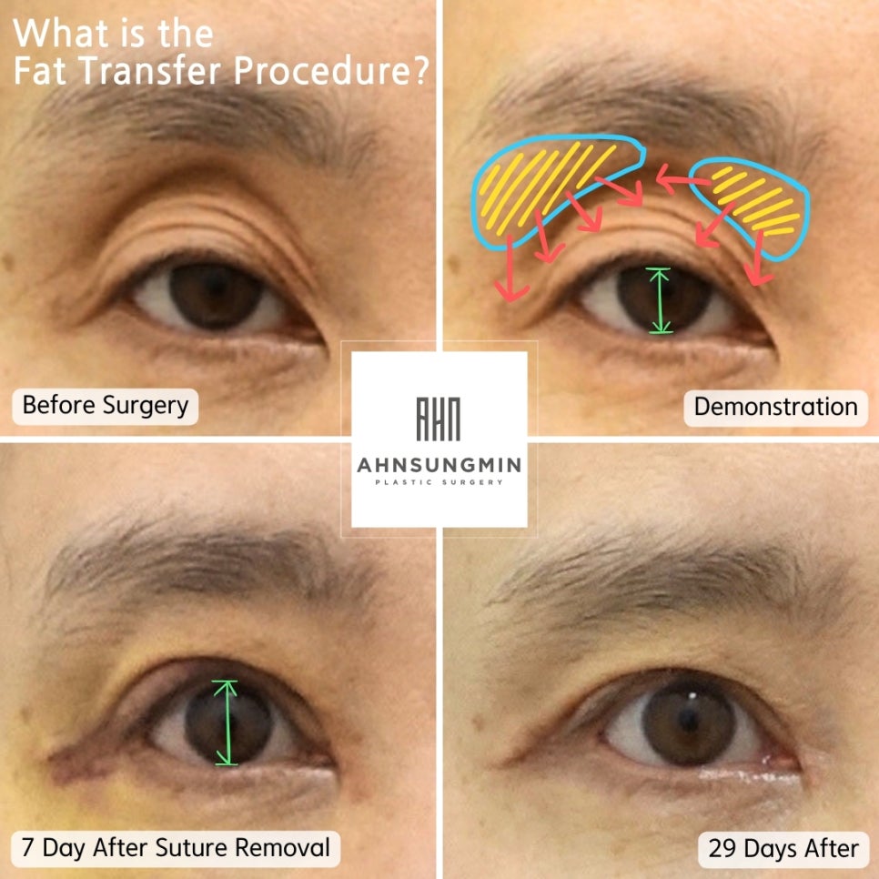 눈재수술 전문 꺼진눈 지방성형 성형외과 전문의 관련 이미지 3