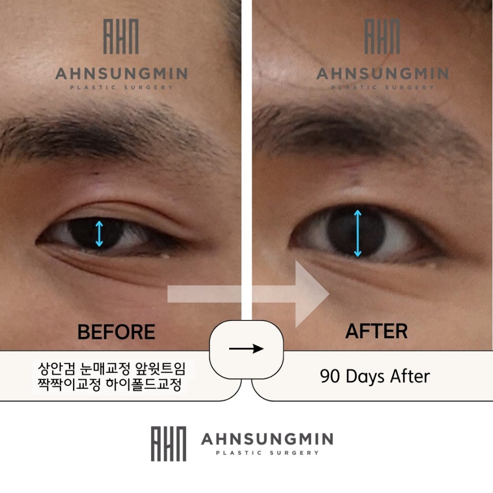 안검하수로 생기는 증상과 안검하수 자가진단 관련 이미지 2