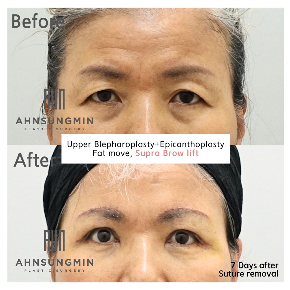 안성민성형외과 눈썹상거상 수술 흉터와 회복기간 [성형외과 전문의 안성민] 관련 이미지 2