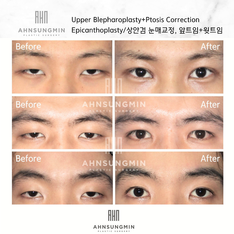 20대 남성 안검하수 증세와 눈매교정 수술 후 3개월 경과 관련 이미지 10
