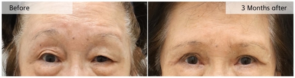 안면신경마비 환자의 눈 성형, 수술의 핵심은 &lsquo;대칭&rsquo; 관련 이미지 2