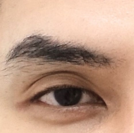 남자 눈성형 두꺼운 쌍꺼풀 풀기 관련 이미지 7