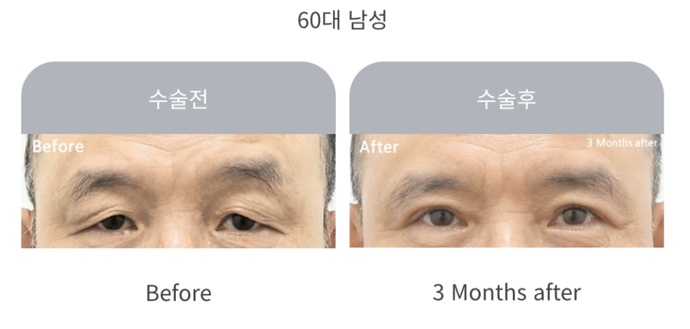 중년 상안검 수술의 특징과 주의사항 관련 이미지 8