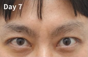 쌍꺼풀 재수술 후 눈은 언제 자연스러워질까? (Day 1부터 6개월 변화) 관련 이미지 5