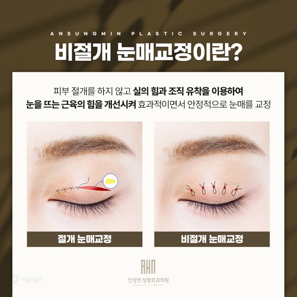잠실성형외과, 눈매교정수술 잘하는 곳 관련 이미지 3