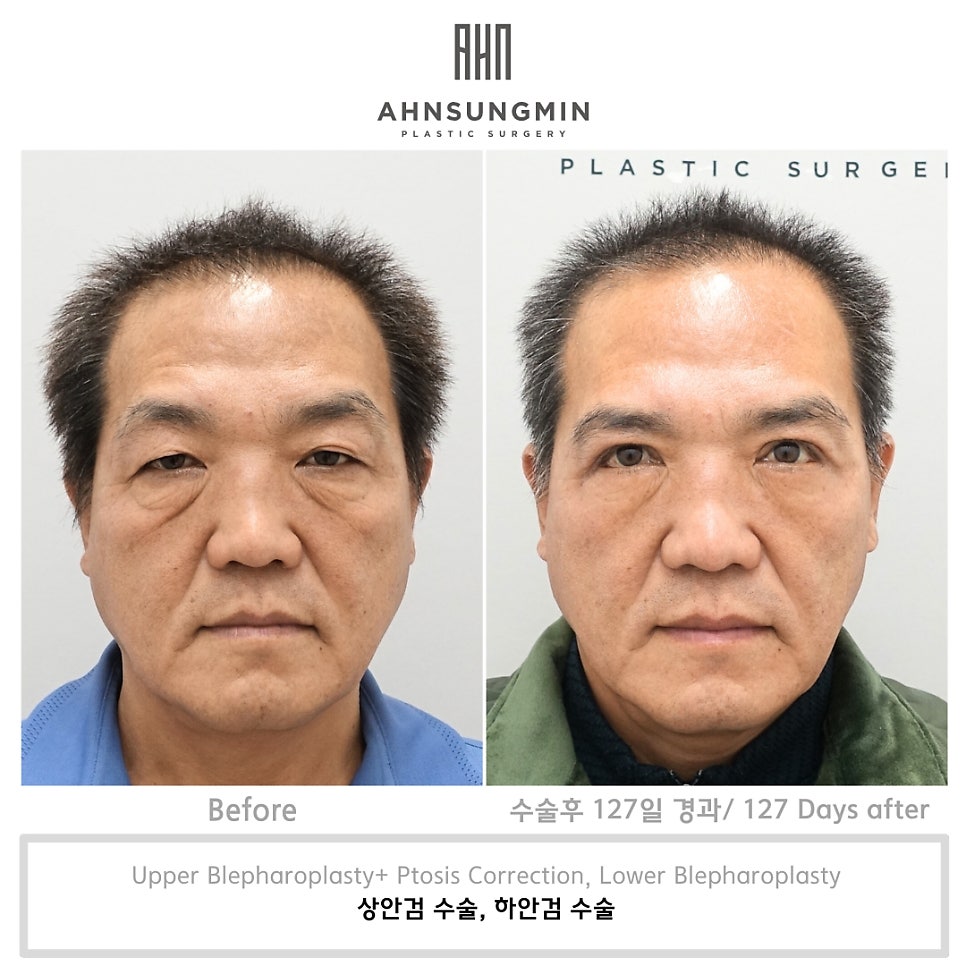 중년 남성 상안검 수술 회복기간 얼마나될까? 관련 이미지 2