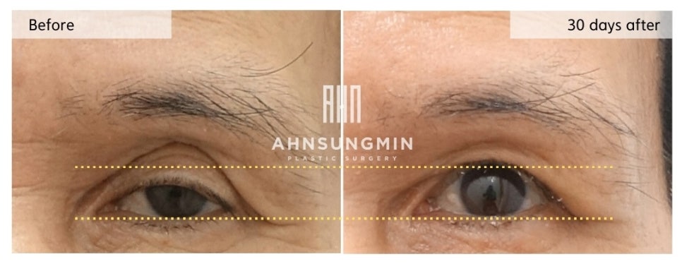 눈꺼풀 꺼짐, 왜 지방이식을 선택하지 않았을까요? 관련 이미지 3