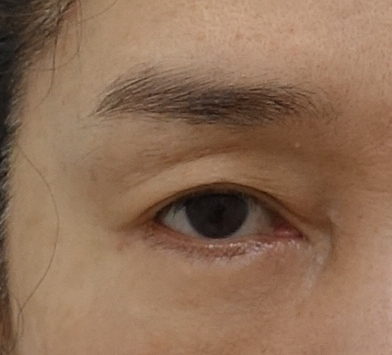 뒷트임과 하안검 수술의 공통 수술 범위. 성형외과 전문의 안성민 관련 이미지 6