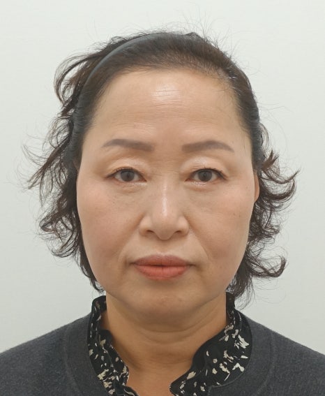 중년 눈 밑 지방 재배치 수술 후 1년 경과 [성형외과 전문의 안성민] 관련 이미지 5