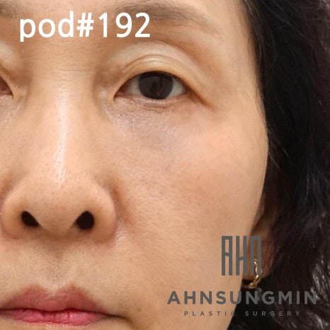 하안검 눈밑지방재배치란 무엇일까요? [지방제거를 하면 안 되는 이유] 관련 이미지 5